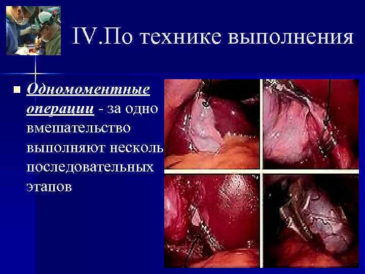    IV. По технике выполнения n  Одномоментные операции - за одно