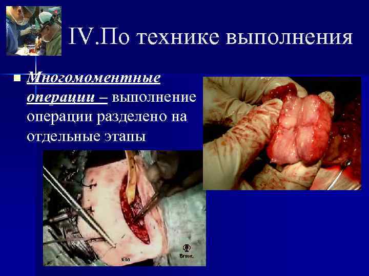    IV. По технике выполнения n  Многомоментные операции – выполнение операции