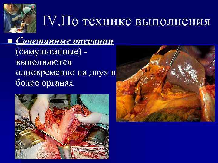    IV. По технике выполнения n  Сочетанные операции (симультанные) - выполняются