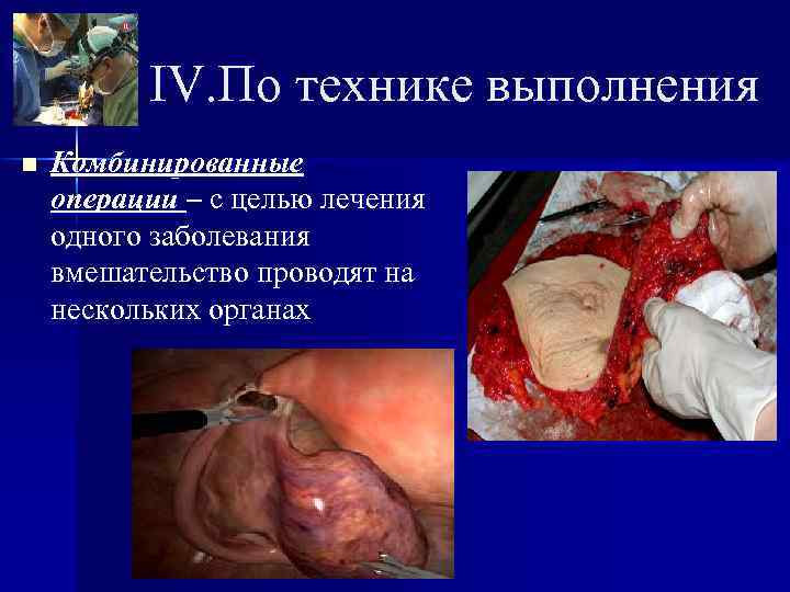    IV. По технике выполнения n  Комбинированные операции – с целью