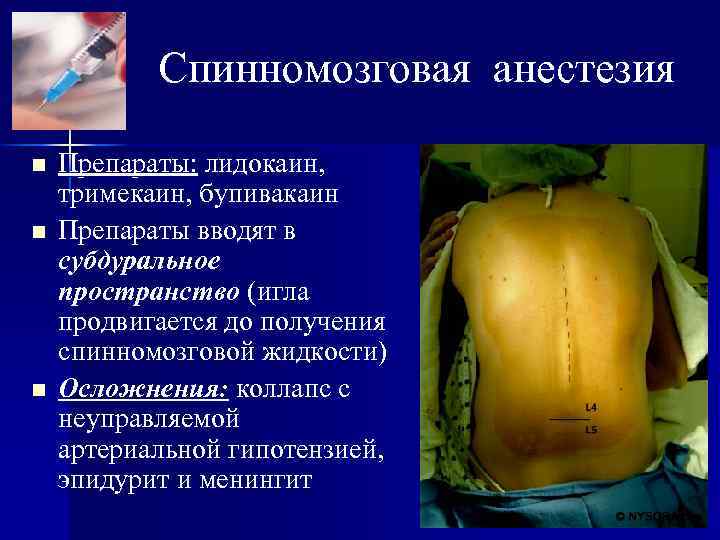 Спинномозговая анестезия n n n Препараты: лидокаин, тримекаин, бупивакаин Препараты вводят в субдуральное пространство