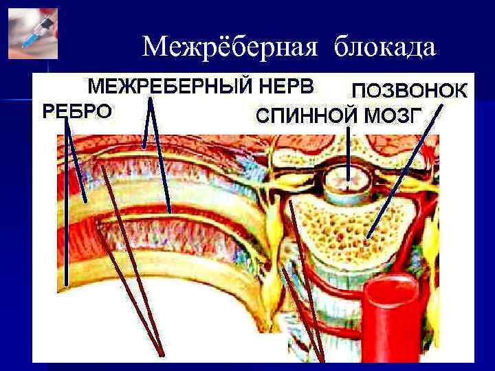 Межрёберная блокада 