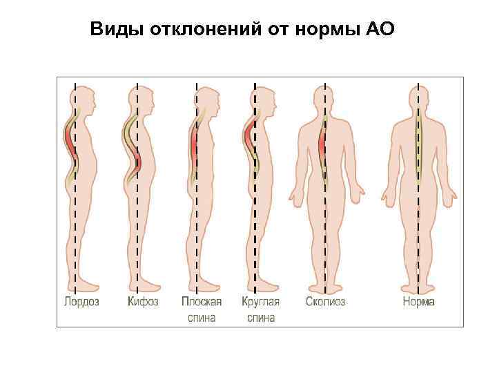 Виды отклонений от нормы АО 
