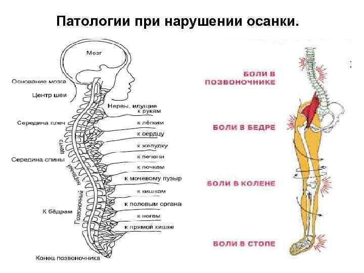 Патологии при нарушении осанки. 