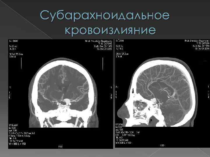 Субарахноидальное кровоизлияние 