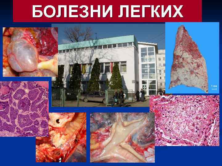 БОЛЕЗНИ ЛЕГКИХ 
