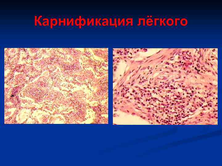 Карнификация лёгкого 
