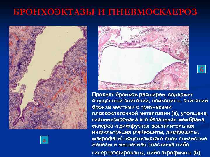 БРОНХОЭКТАЗЫ И ПНЕВМОСКЛЕРОЗ б а Просвет бронхов расширен, содержит слущенный эпителий, лейкоциты, эпителий бронха