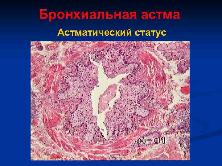 Бронхиальная астма Астматический статус 