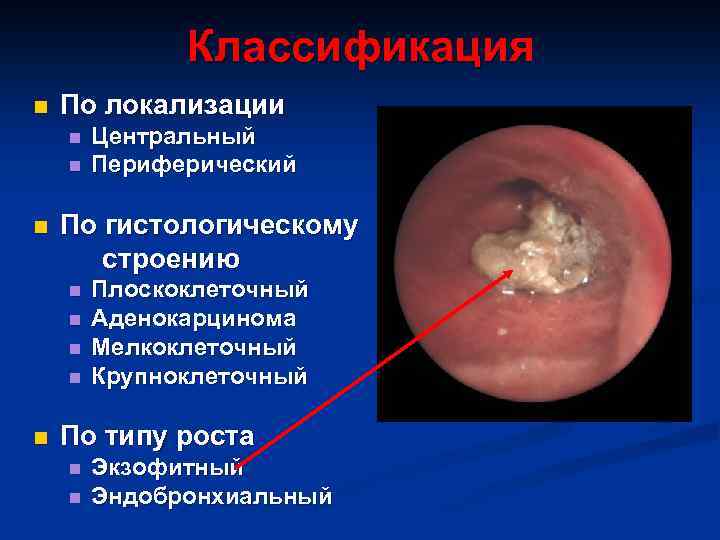 Классификация n По локализации n n Центральный Периферический По гистологическому строению n n n