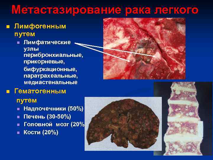 Метастазирование рака легкого n Лимфогенным путем Лимфатические узлы перибронхиальные, прикорневые, бифуркационные, паратрахеальные, медиастенальные n