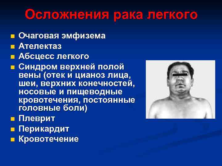 Осложнения рака легкого n n n n Очаговая эмфизема Ателектаз Абсцесс легкого Синдром верхней