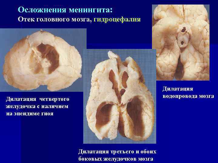 Осложнения менингита: Отек головного мозга, гидроцефалия Дилатация водопровода мозга Дилатация четвертого желудочка с наличием