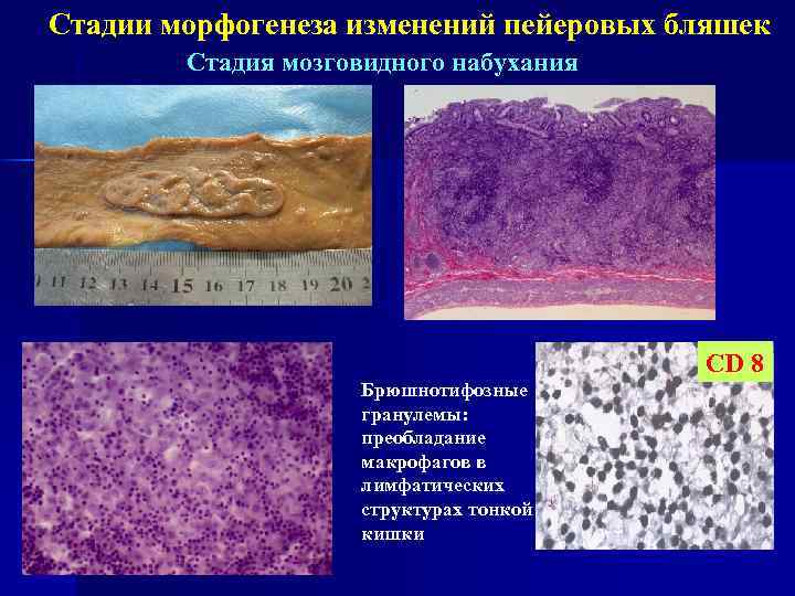 Стадии морфогенеза изменений пейеровых бляшек Стадия мозговидного набухания CD 8 Брюшнотифозные гранулемы: преобладание макрофагов
