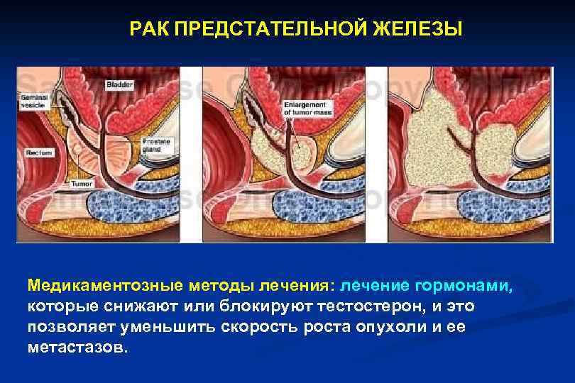 РАК ПРЕДСТАТЕЛЬНОЙ ЖЕЛЕЗЫ Медикаментозные методы лечения: лечение гормонами, которые снижают или блокируют тестостерон, и