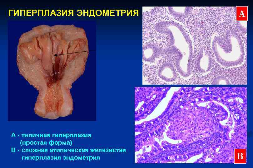 Мр картина гиперплазии предстательной железы