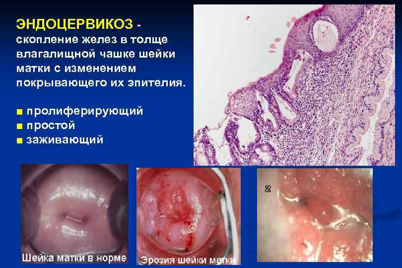 ЭНДОЦЕРВИКОЗ - скопление желез в толще влагалищной чашке шейки матки с изменением покрывающего их
