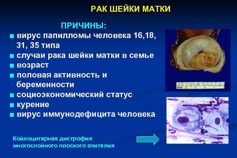 РАК ШЕЙКИ МАТКИ ПРИЧИНЫ: ■ вирус папилломы человека 16, 18, 31, 35 типа ■