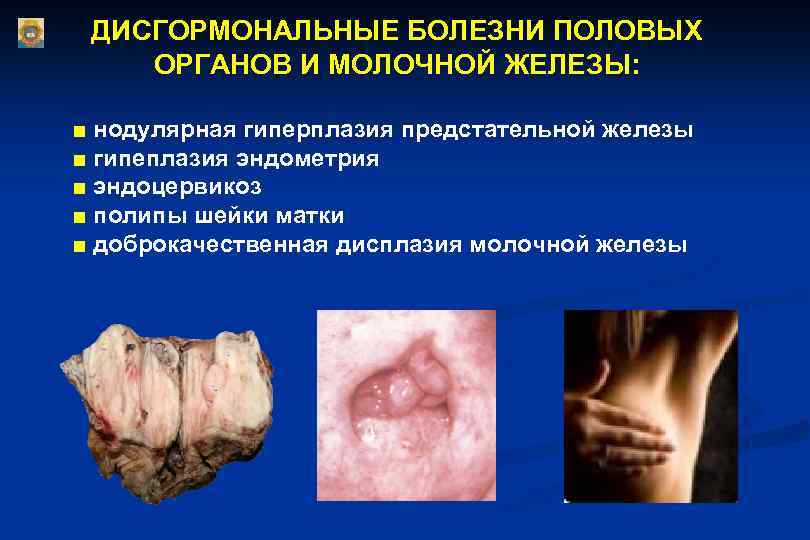 ДИСГОРМОНАЛЬНЫЕ БОЛЕЗНИ ПОЛОВЫХ ОРГАНОВ И МОЛОЧНОЙ ЖЕЛЕЗЫ: ■ нодулярная гиперплазия предстательной железы ■ гипеплазия