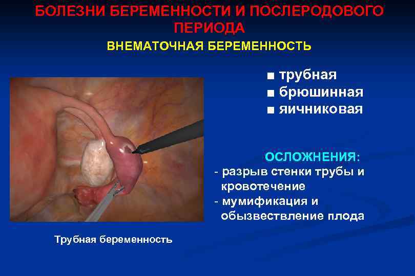 БОЛЕЗНИ БЕРЕМЕННОСТИ И ПОСЛЕРОДОВОГО ПЕРИОДА ВНЕМАТОЧНАЯ БЕРЕМЕННОСТЬ ■ трубная ■ брюшинная ■ яичниковая ОСЛОЖНЕНИЯ: