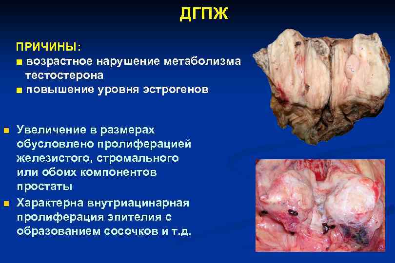 ДГПЖ ПРИЧИНЫ: ■ возрастное нарушение метаболизма тестостерона ■ повышение уровня эстрогенов n n Увеличение