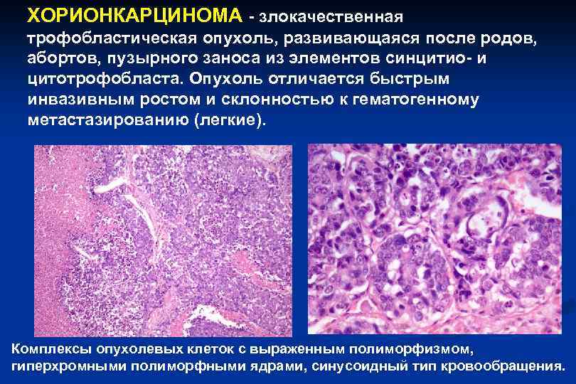 Злокачественную опухоль отличает. Трофобластическая болезнь гистология. Хорионэпителиома гистология. Хорионкарцинома матки микропрепарат. Хориокарцинома патанатомия.