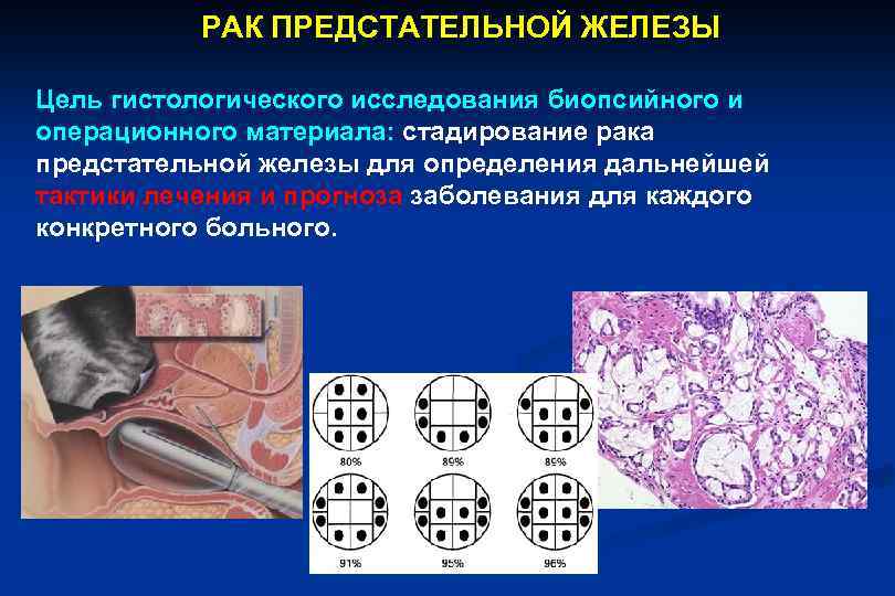 РАК ПРЕДСТАТЕЛЬНОЙ ЖЕЛЕЗЫ Цель гистологического исследования биопсийного и операционного материала: стадирование рака предстательной железы