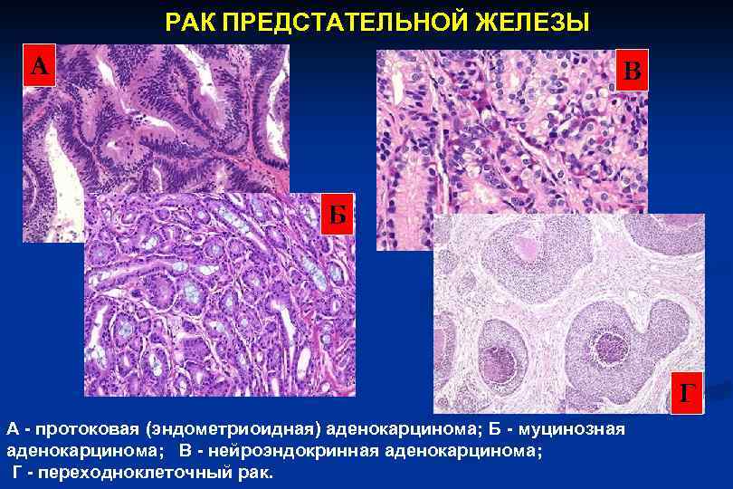 РАК ПРЕДСТАТЕЛЬНОЙ ЖЕЛЕЗЫ А В Б Г А - протоковая (эндометриоидная) аденокарцинома; Б -