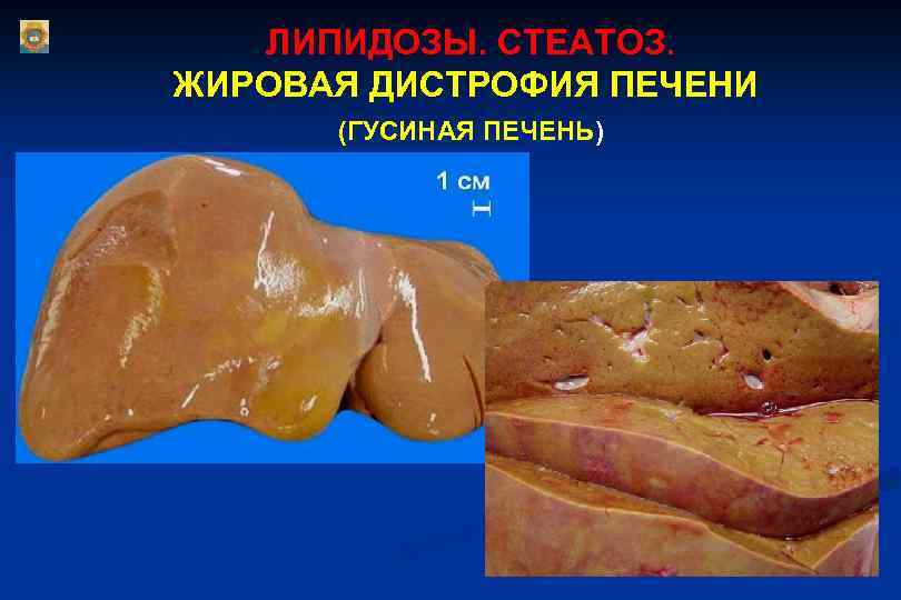 ЛИПИДОЗЫ. СТЕАТОЗ. ЖИРОВАЯ ДИСТРОФИЯ ПЕЧЕНИ (ГУСИНАЯ ПЕЧЕНЬ) 
