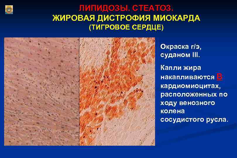 ЛИПИДОЗЫ. СТЕАТОЗ. ЖИРОВАЯ ДИСТРОФИЯ МИОКАРДА (ТИГРОВОЕ СЕРДЦЕ) Окраска г/э, суданом III. Капли жира накапливаются