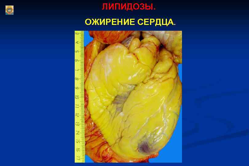 ЛИПИДОЗЫ. ОЖИРЕНИЕ СЕРДЦА. 