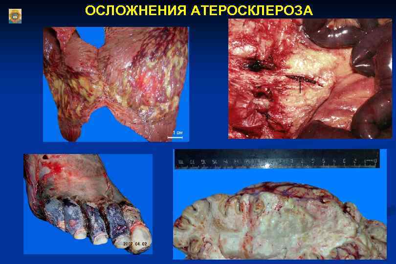 ОСЛОЖНЕНИЯ АТЕРОСКЛЕРОЗА 