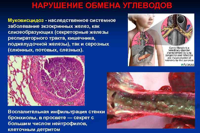 НАРУШЕНИЕ ОБМЕНА УГЛЕВОДОВ Муковисцидоз - наследственное системное заболевание экзокринных желез, как слизеобразующих (секреторные железы