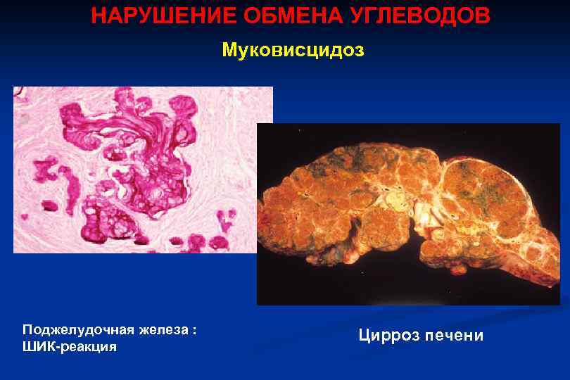 НАРУШЕНИЕ ОБМЕНА УГЛЕВОДОВ Муковисцидоз Поджелудочная железа : ШИК-реакция Цирроз печени 