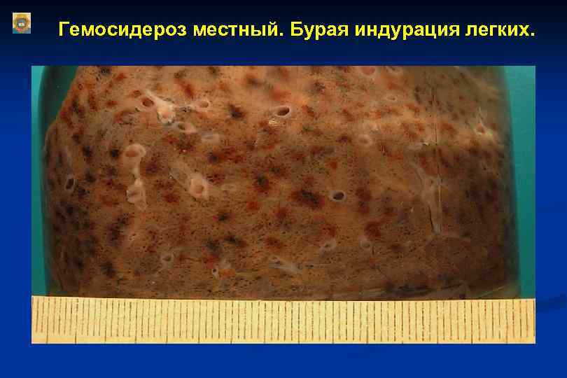 Гемосидероз местный. Бурая индурация легких. 