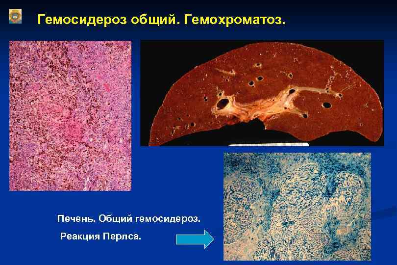 Гемосидероз общий. Гемохроматоз. Печень. Общий гемосидероз. Реакция Перлса. 