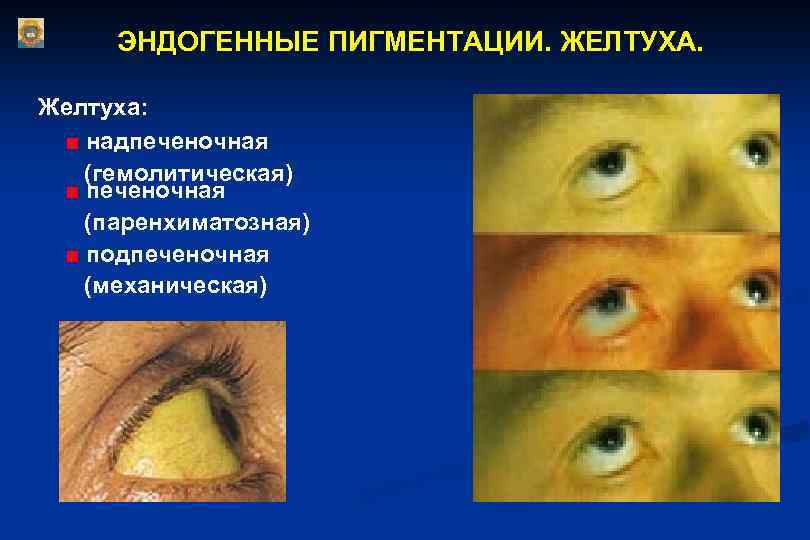 ЭНДОГЕННЫЕ ПИГМЕНТАЦИИ. ЖЕЛТУХА. Желтуха: ■ надпеченочная (гемолитическая) ■ печеночная (паренхиматозная) ■ подпеченочная (механическая) 