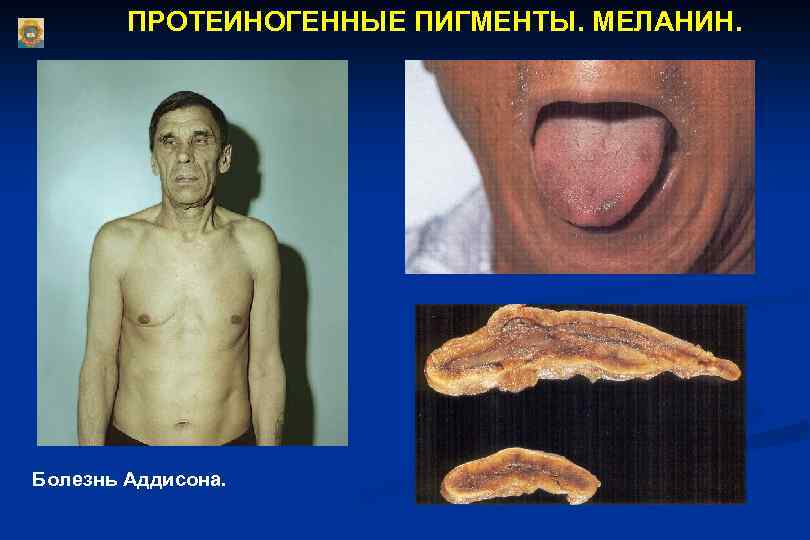ПРОТЕИНОГЕННЫЕ ПИГМЕНТЫ. МЕЛАНИН. Болезнь Аддисона. 