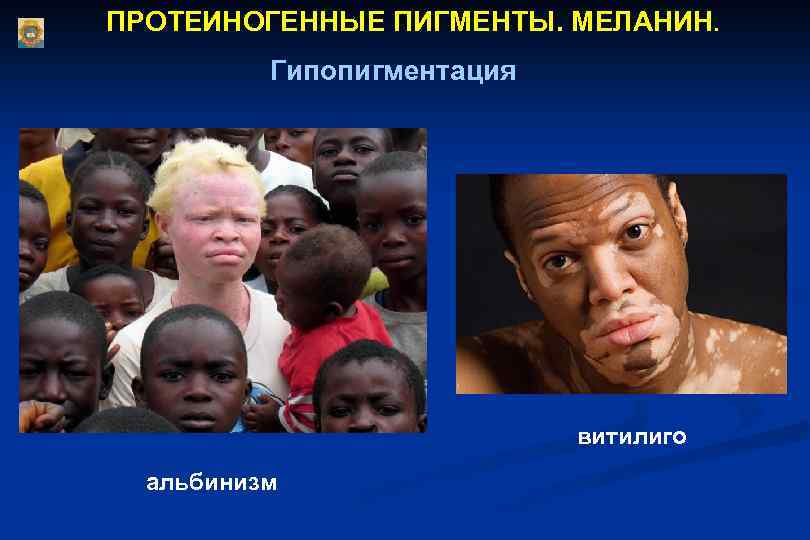 ПРОТЕИНОГЕННЫЕ ПИГМЕНТЫ. МЕЛАНИН. Гипопигментация витилиго альбинизм 