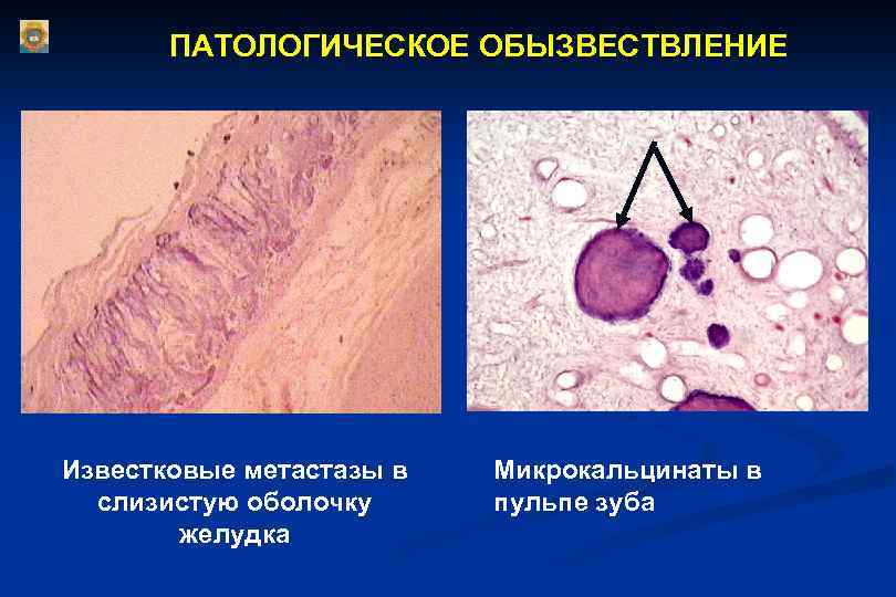 ПАТОЛОГИЧЕСКОЕ ОБЫЗВЕСТВЛЕНИЕ Известковые метастазы в слизистую оболочку желудка Микрокальцинаты в пульпе зуба 