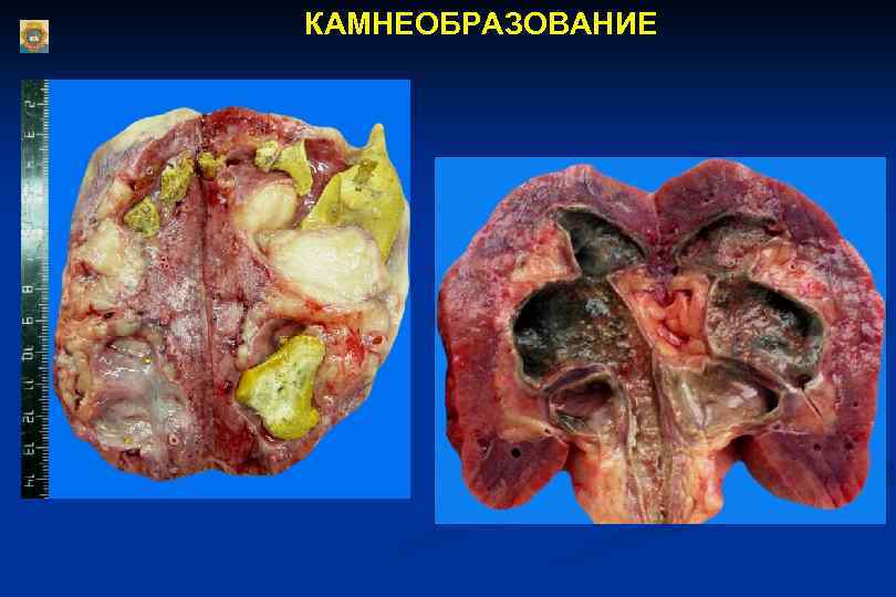 КАМНЕОБРАЗОВАНИЕ 