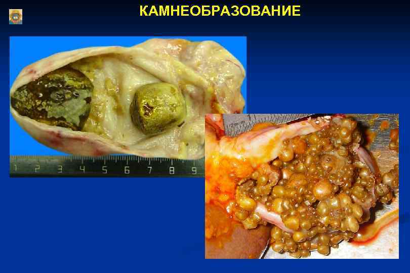 КАМНЕОБРАЗОВАНИЕ 