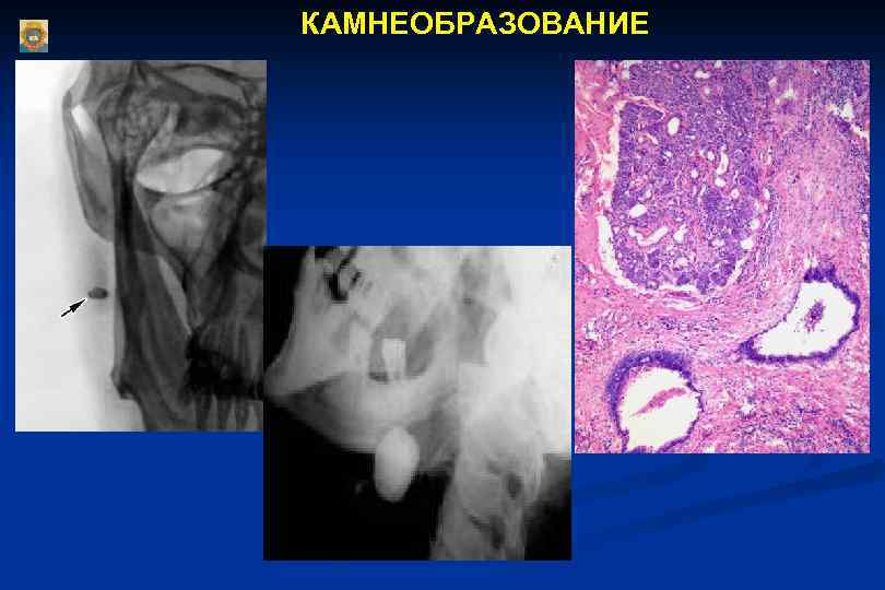 КАМНЕОБРАЗОВАНИЕ 