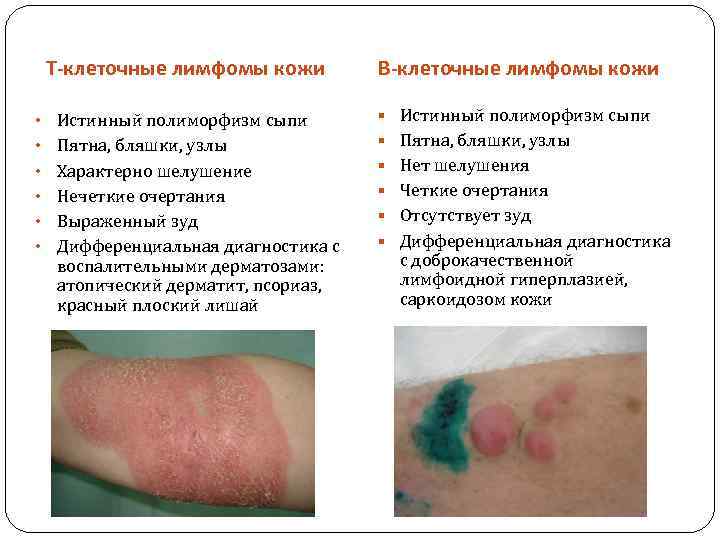 Т-клеточные лимфомы кожи • • • Истинный полиморфизм сыпи Пятна, бляшки, узлы Характерно шелушение
