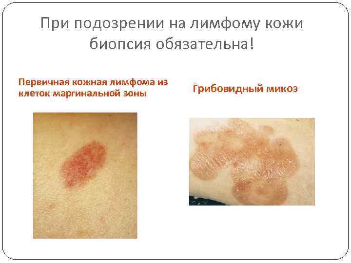 При подозрении на лимфому кожи биопсия обязательна! Первичная кожная лимфома из клеток маргинальной зоны