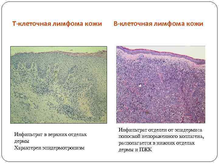 Т-клеточная лимфома кожи Инфильтрат в верхних отделах дермы Характерен эпидермотропизм В-клеточная лимфома кожи Инфильтрат