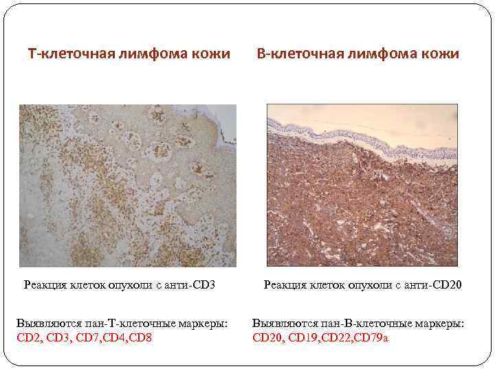 Т-клеточная лимфома кожи Реакция клеток опухоли с анти-CD 3 Выявляются пан-Т-клеточные маркеры: CD 2,