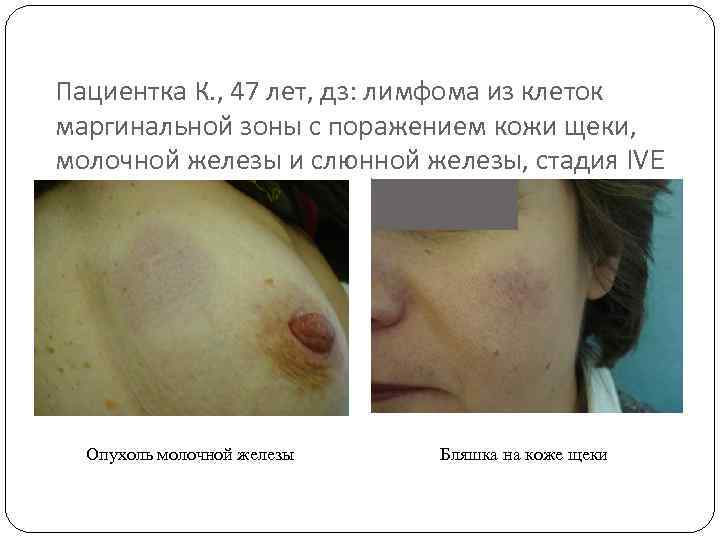 Пациентка К. , 47 лет, дз: лимфома из клеток маргинальной зоны с поражением кожи