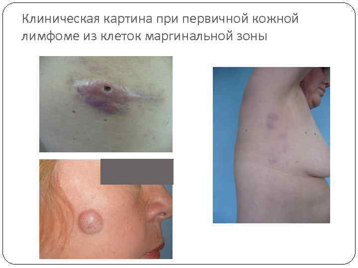 Клиническая картина при первичной кожной лимфоме из клеток маргинальной зоны 
