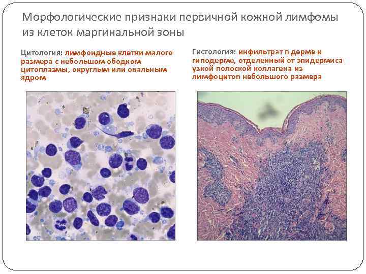 Морфологические признаки первичной кожной лимфомы из клеток маргинальной зоны Цитология: лимфоидные клетки малого размера